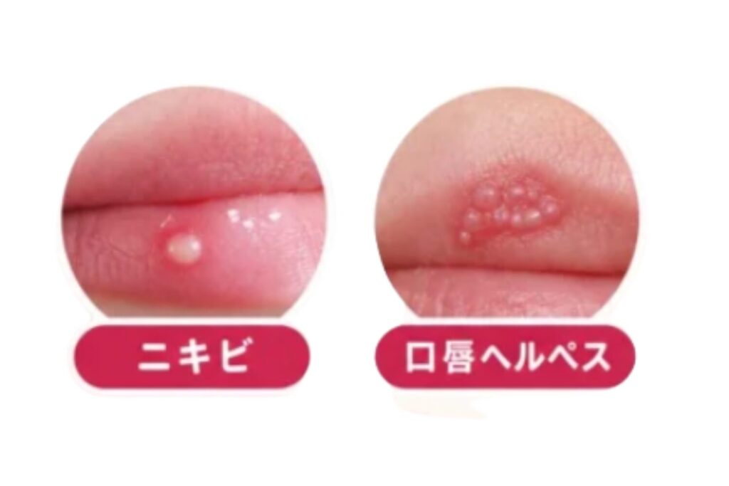 見た目の違い（ニキビは白〜赤い盛り上がり、ヘルペスは水ぶくれ）