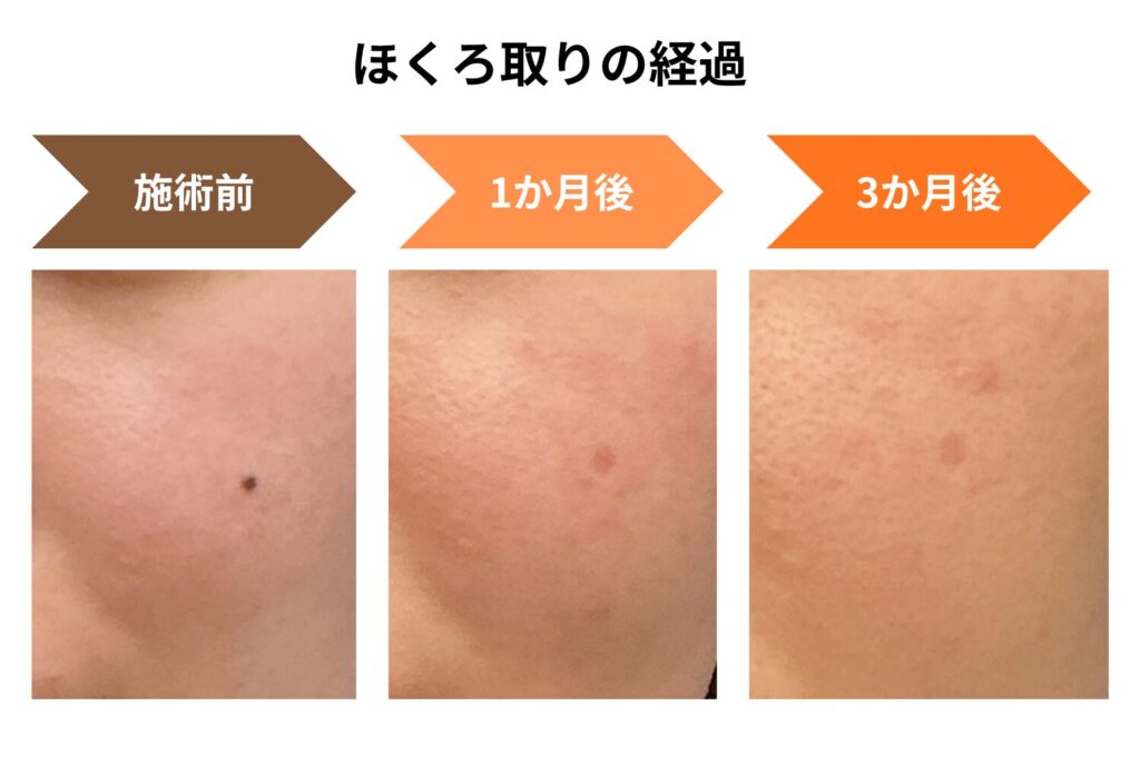 ほくろが気になるならほくろ取りから始める
