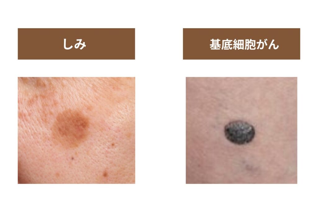 基底細胞がん