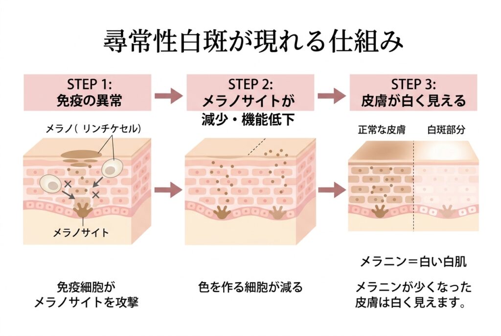 尋常性白斑の主な原因
