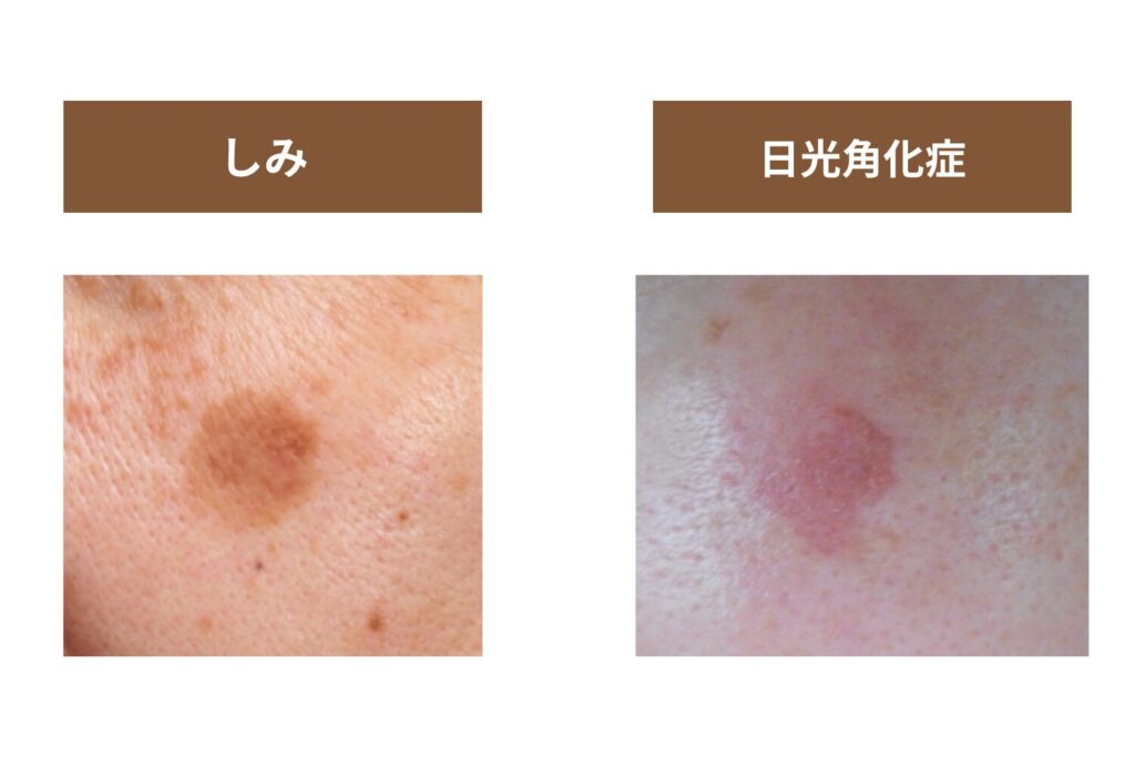 日光角化症(前がん病変)
