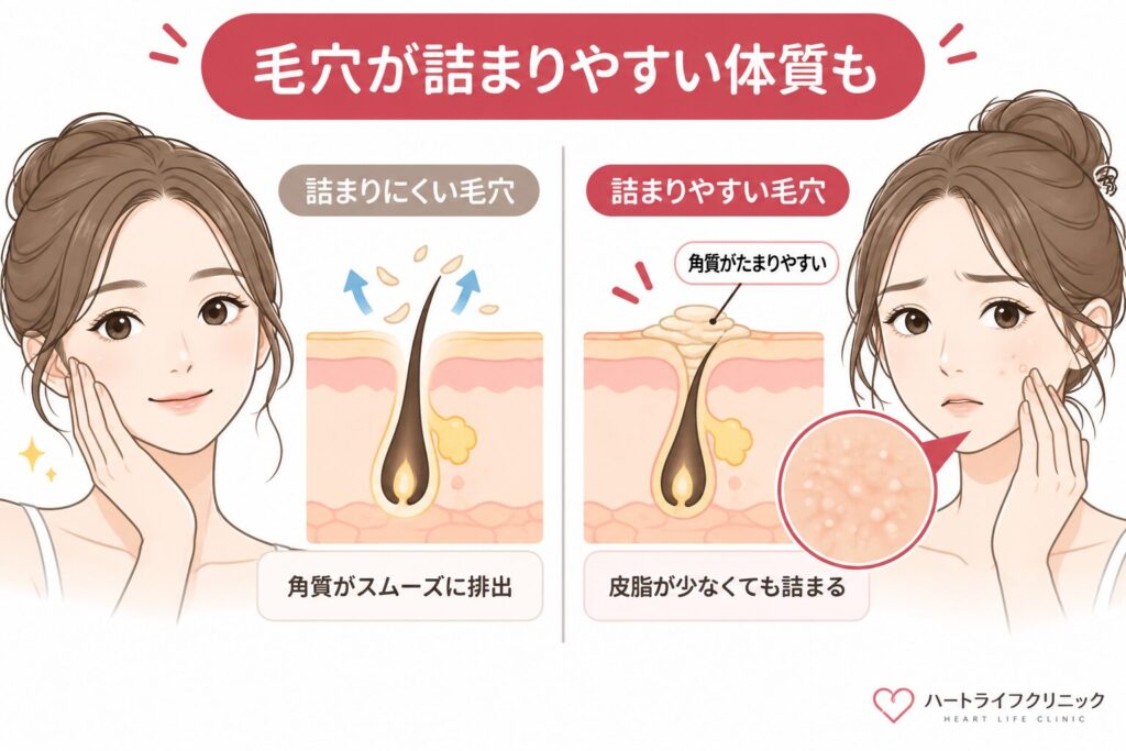 毛穴が詰まりやすい肌質は体質の影響を受ける