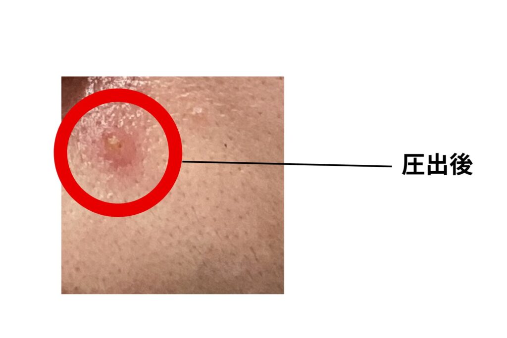 圧出後は赤みや小さな傷が残ることがある
