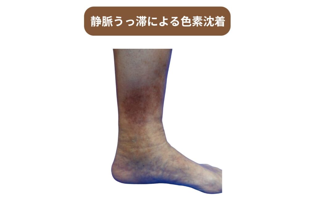 静脈うっ滞による色素沈着