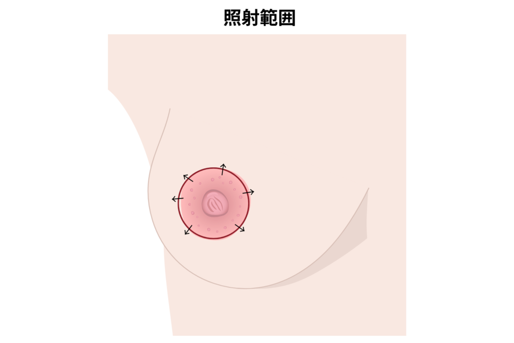 乳輪の周囲(乳輪の縁の外側)が基本の照射範囲