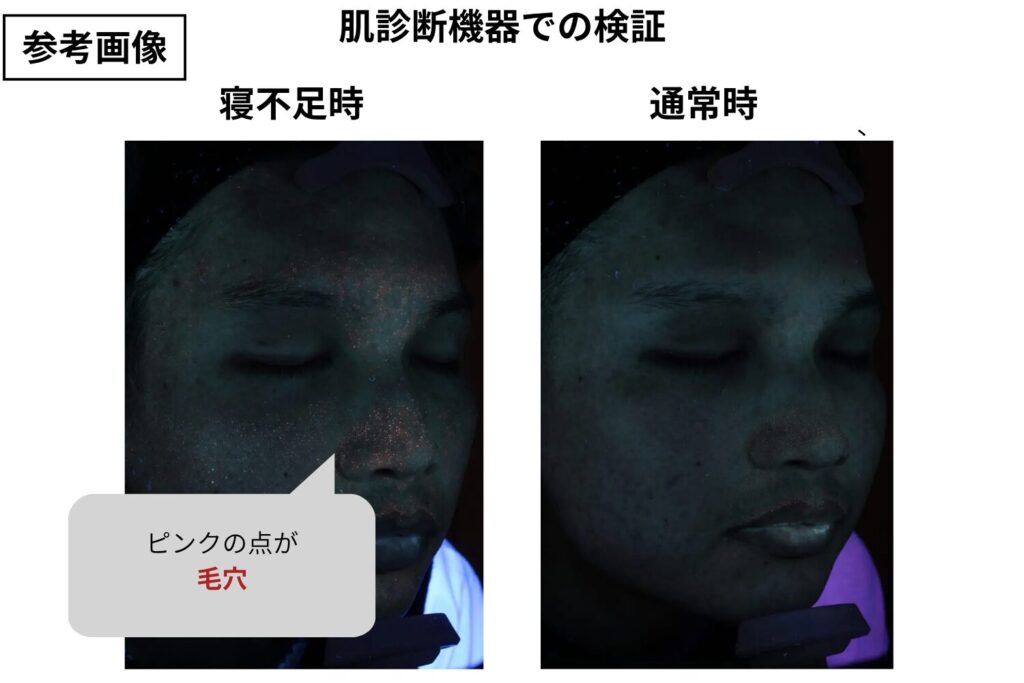 皮脂が増えて毛穴が詰まりやすくなる