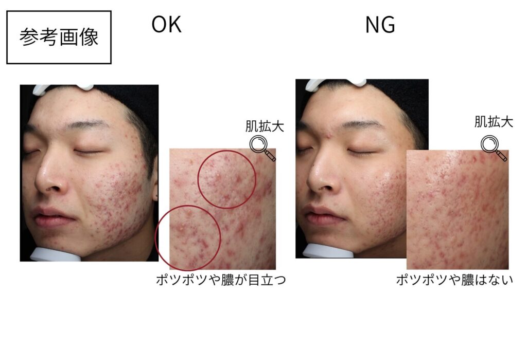 赤く腫れたニキビや膿を持ったニキビが残っている