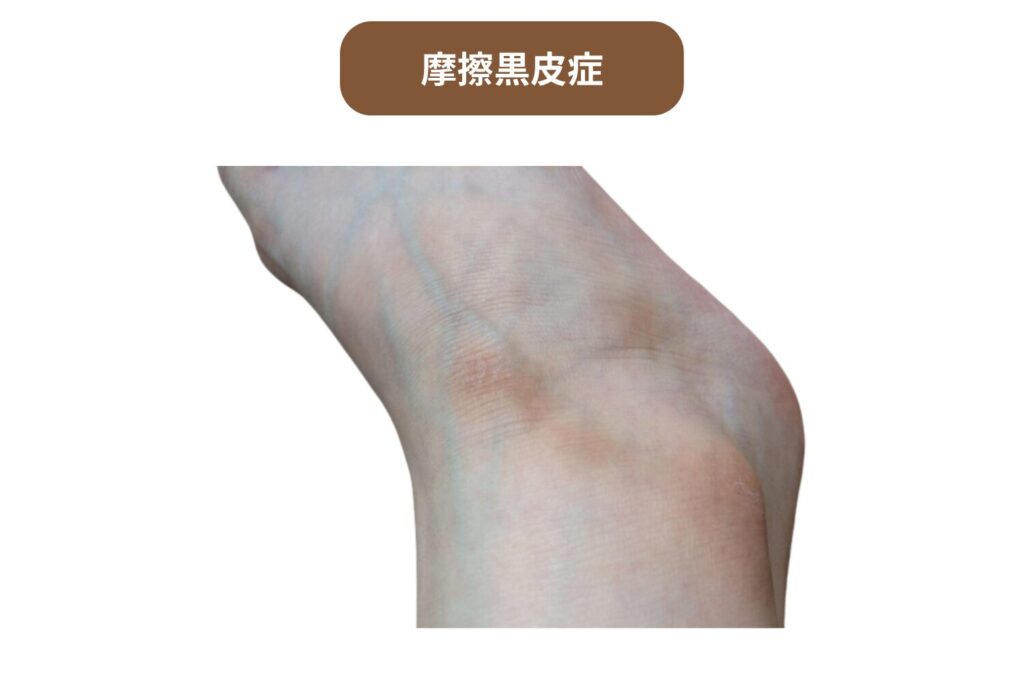 摩擦黒皮症