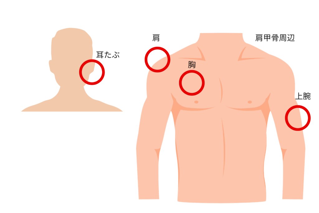 ケロイドができやすい部位