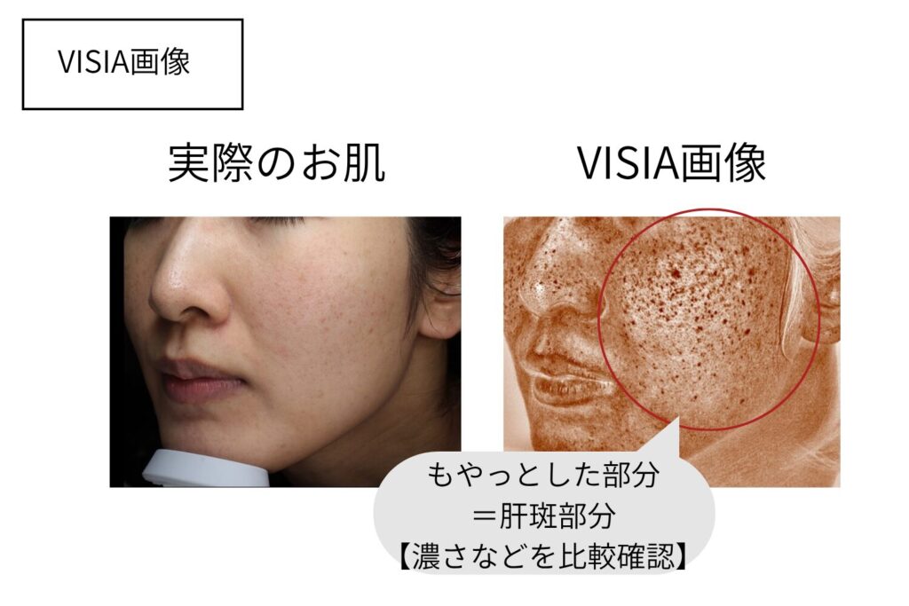 数週間たっても濃さが戻らない場合は照射の見直しが必要