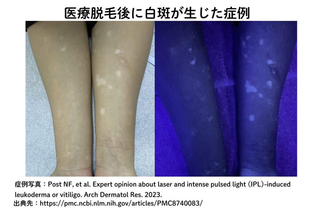 医療脱毛で白斑が起こることはある？