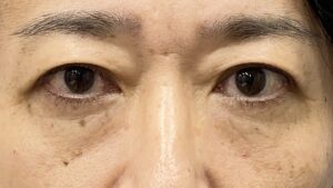 くまとり術後