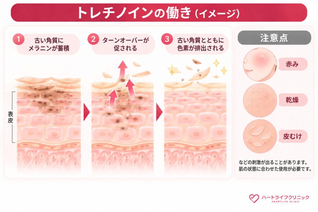トレチノイン：ターンオーバーを促し、できた色素を排出する