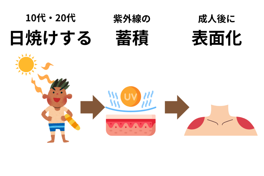 過去の強い日焼けはいつシミになる？