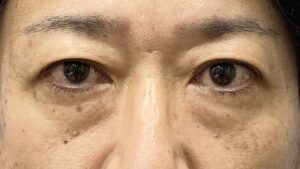 くまとり術前
