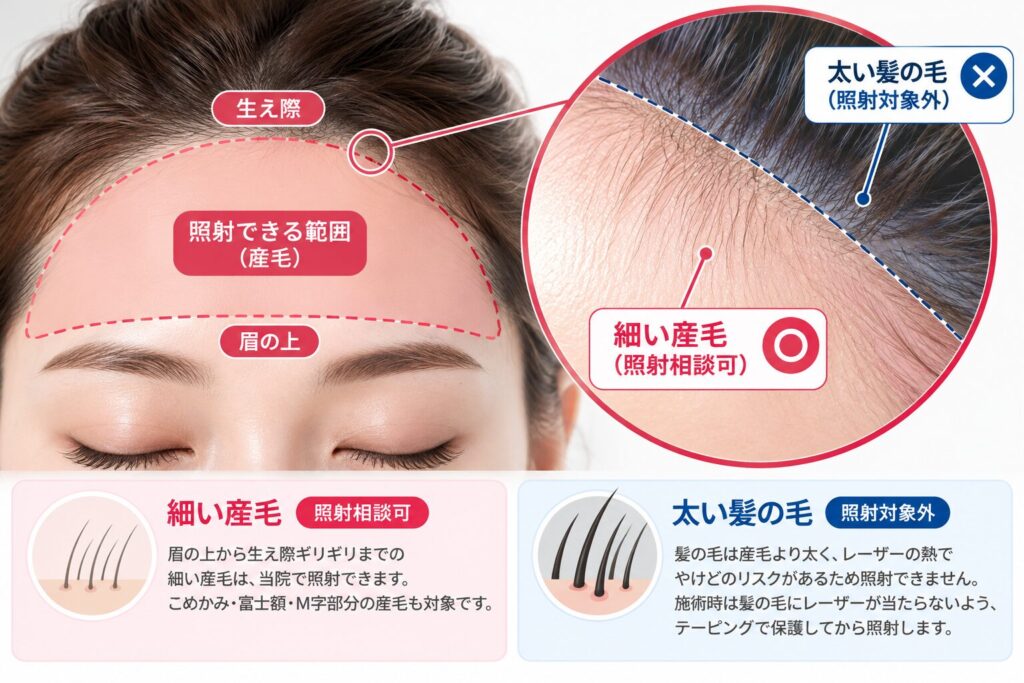 おでこを広くしたい場合は髪の毛への照射に注意が必要