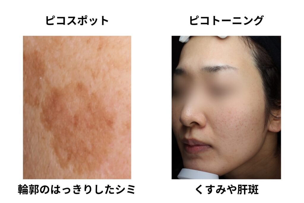 点状のシミにはピコスポット、広がる色ムラにはピコトーニング