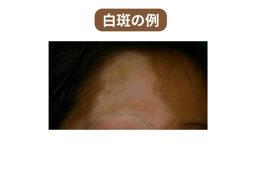 シミが薄くなって周囲が明るく見える「良い変化」との違い(白斑)