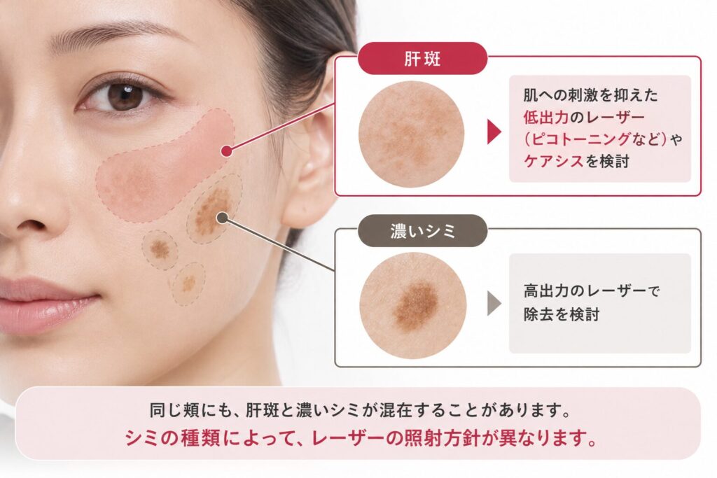強いレーザーは肝斑を濃くすることがある