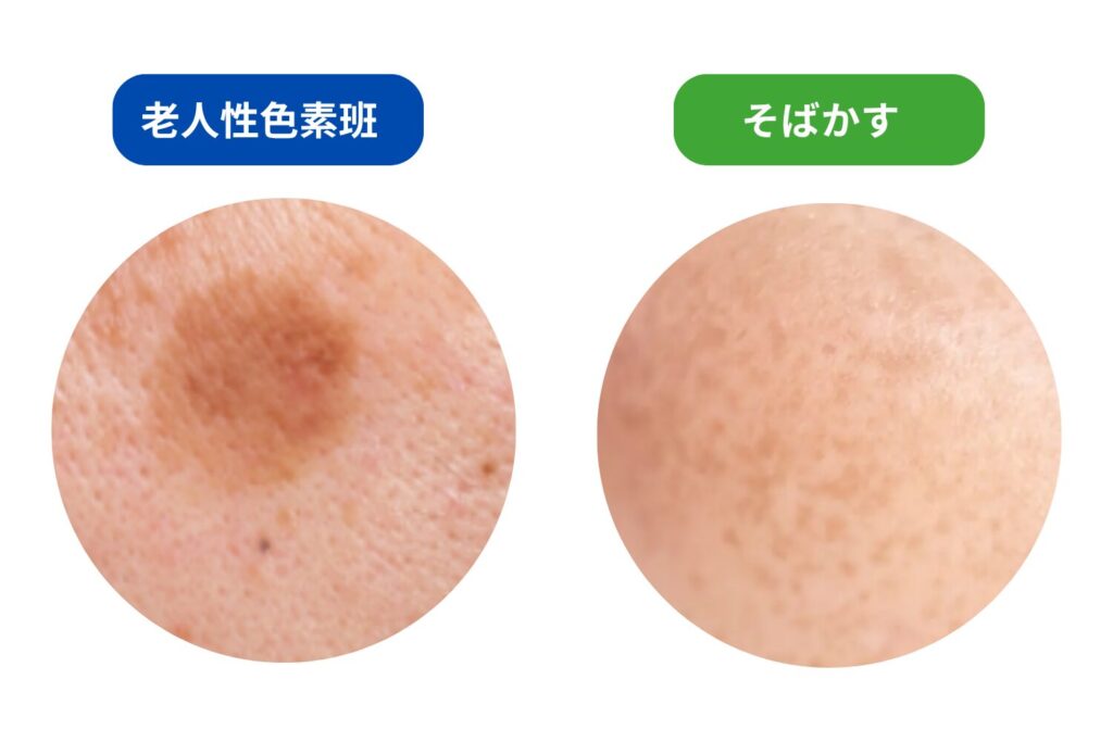 輪郭がはっきりした平らな茶色は、老人性色素斑かそばかす