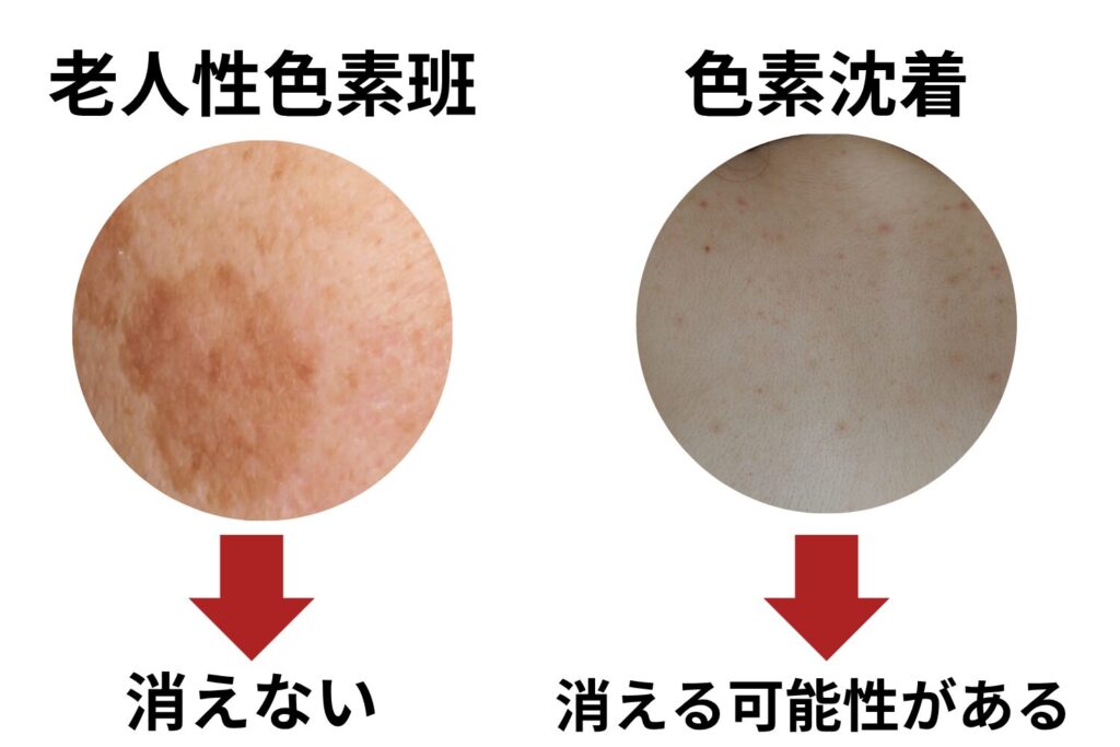 肩のシミを放置するとどうなるか？
