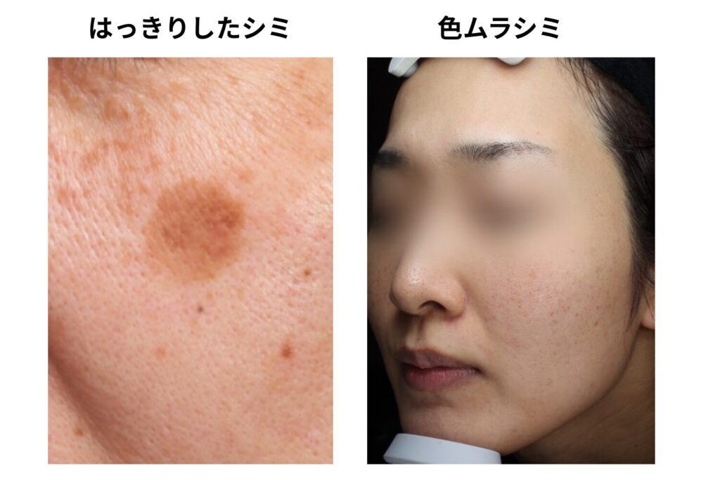 効果を感じないときはシミの種類を見直す