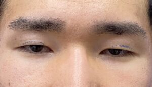 二重ビフォー