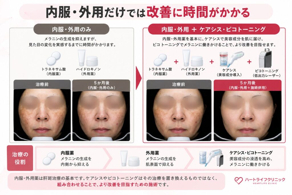 内服・外用だけでは改善に時間がかかる