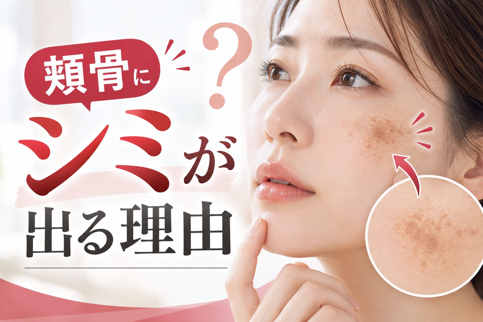 頬骨にシミが出る理由|高い位置に集まる原因と見分け方・治療の選び方