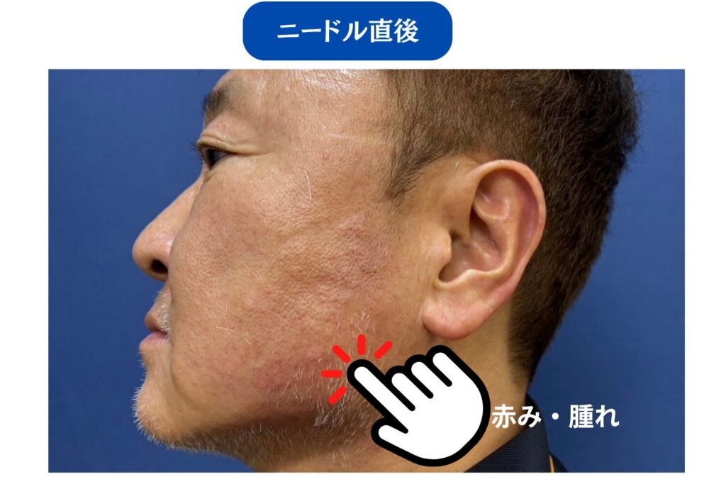 後遺症と間違えやすい一時的な炎症反応