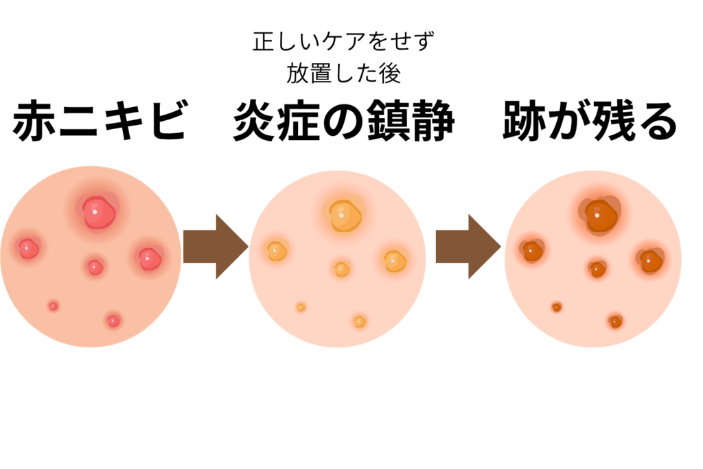 ニキビや虫刺されの炎症は茶色い跡として残ることがある