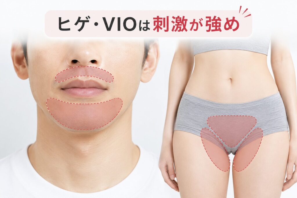 YAG(1064nm)に切り替える部位:ヒゲ・VIOは最も痛みを感じやすい